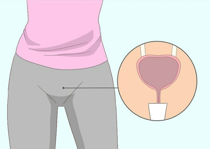 阴道松弛症,凯格尔训练无效怎么办?