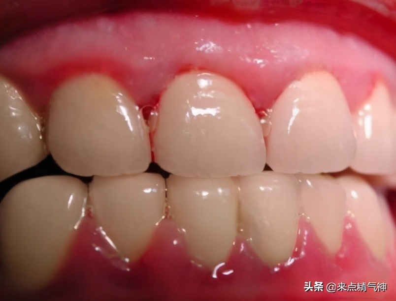 牙疼口臭是肝火还是胃火,口臭牙龈长泡是胃虚火还是胃实火