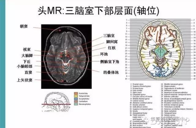 电子版头颅ct与mri断层解剖,头颅mri血管解剖与分段详解