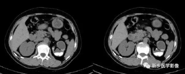 腹部平片能看到结石吗,腹部高密度结节影是什么