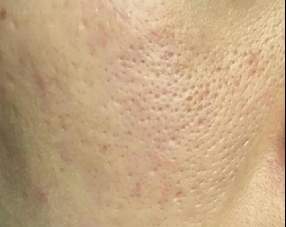 皮肤粗糙毛孔粗大最快的解决办法,皮肤松弛毛孔粗大黑头多怎么解决