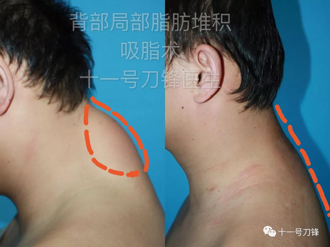 负压吸脂和射频吸脂,光纤溶脂和负压吸脂优缺点