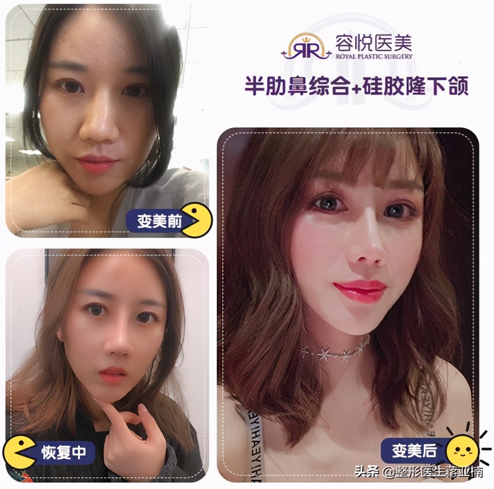 怎么判断隆鼻假体歪了,假体隆鼻切口外露修复