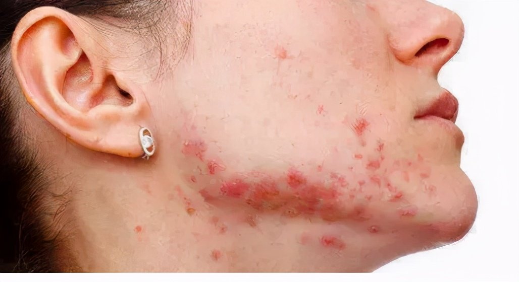 脸上长痘是身体原因还是皮肤原因,脸上长痘可能是什么病引起的