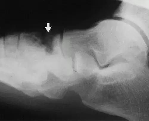 神经性骨关节病,神经性关节炎症状图片