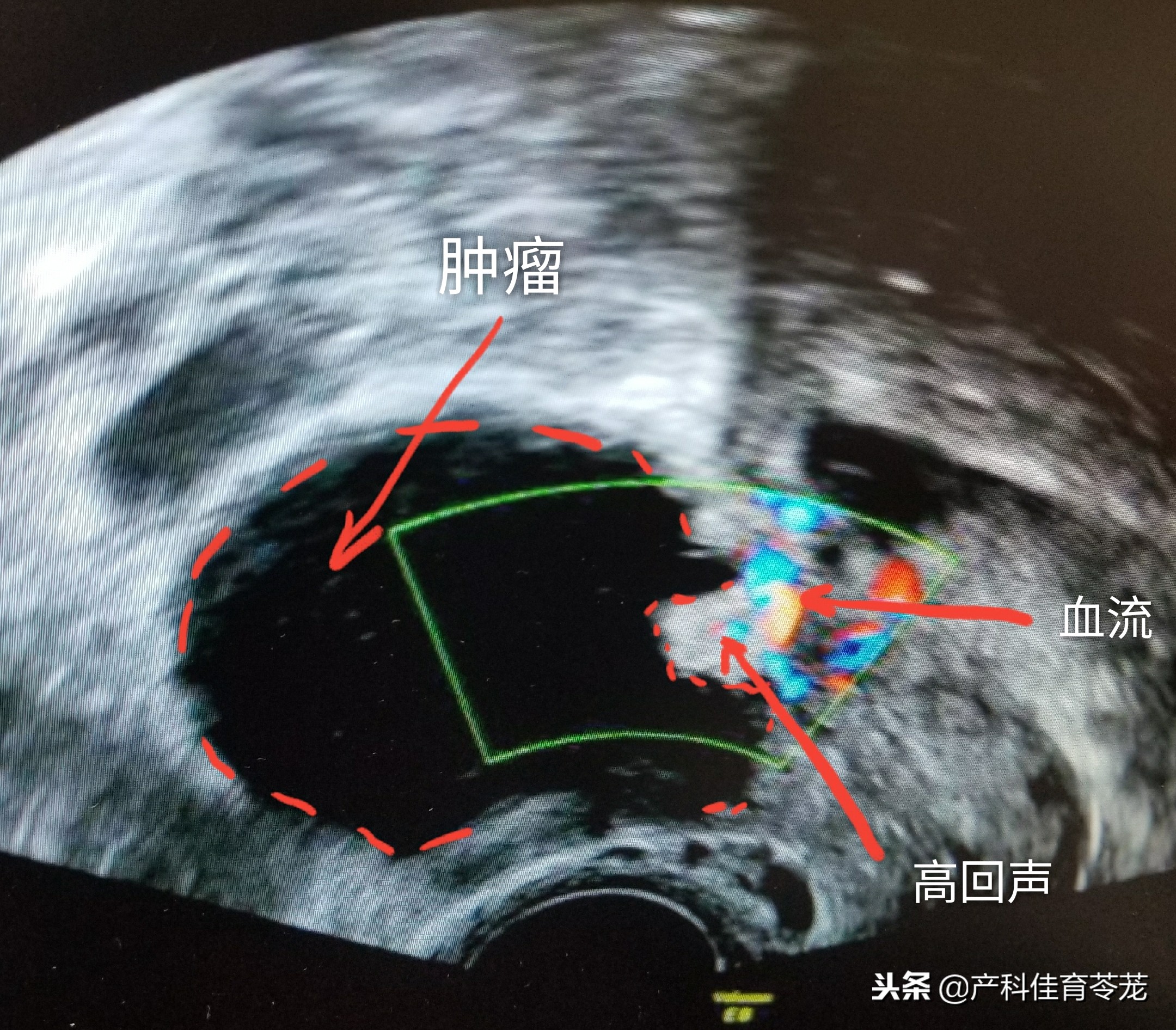 做b超能看见卵巢吗,妇科b超结果显示卵巢什么意思