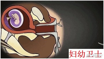 人流对生育影响有多大,人流不干净二次清宫影响怀孕吗