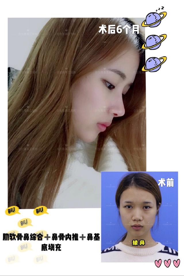 隆鼻手术十大常见问题的应对方案,隆鼻手术前应该准备带什么东西