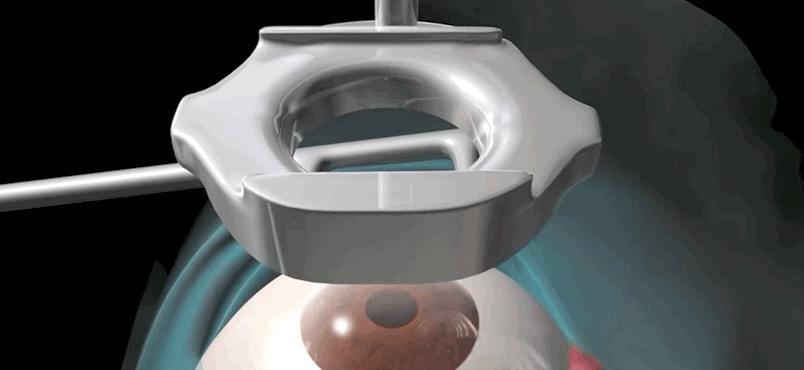 激光近视矫正手术有什么后遗症,激光矫正近视和散光有什么后遗症