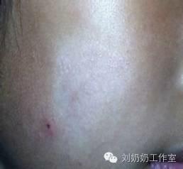 起白斑是什么原因,起白斑就是白癜风吗