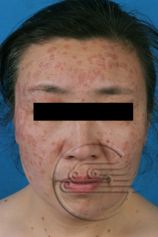 传染性软疣儿童怎么治可以断根,儿童脸上长了传染性软疣怎么办