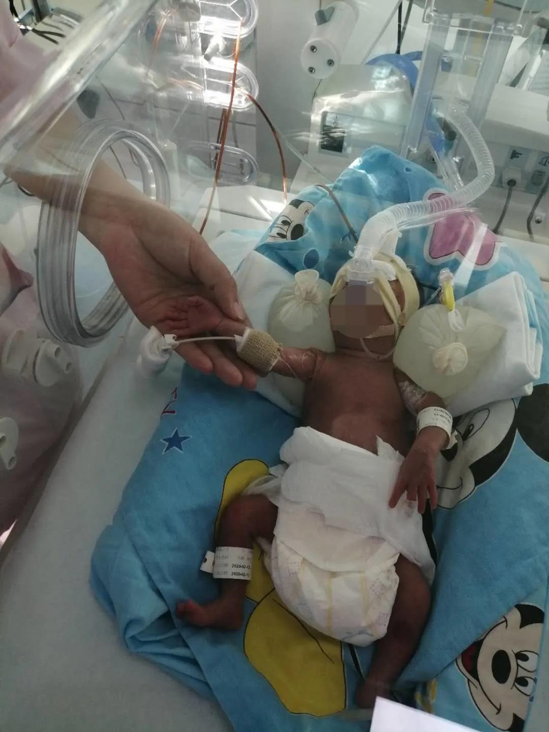 29周胎膜早破出生胎儿,双胞胎孕3月胎膜早破