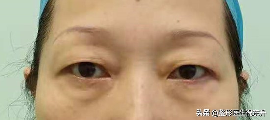 双眼皮全切加祛眼袋后1-7天恢复图,做完提眉去眼袋手术流泪