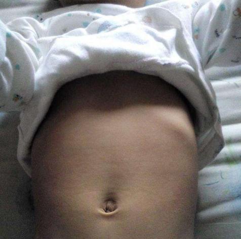 儿童脑袋中间凹下去是什么原因,小孩头顶凹下去一块是怎么回事