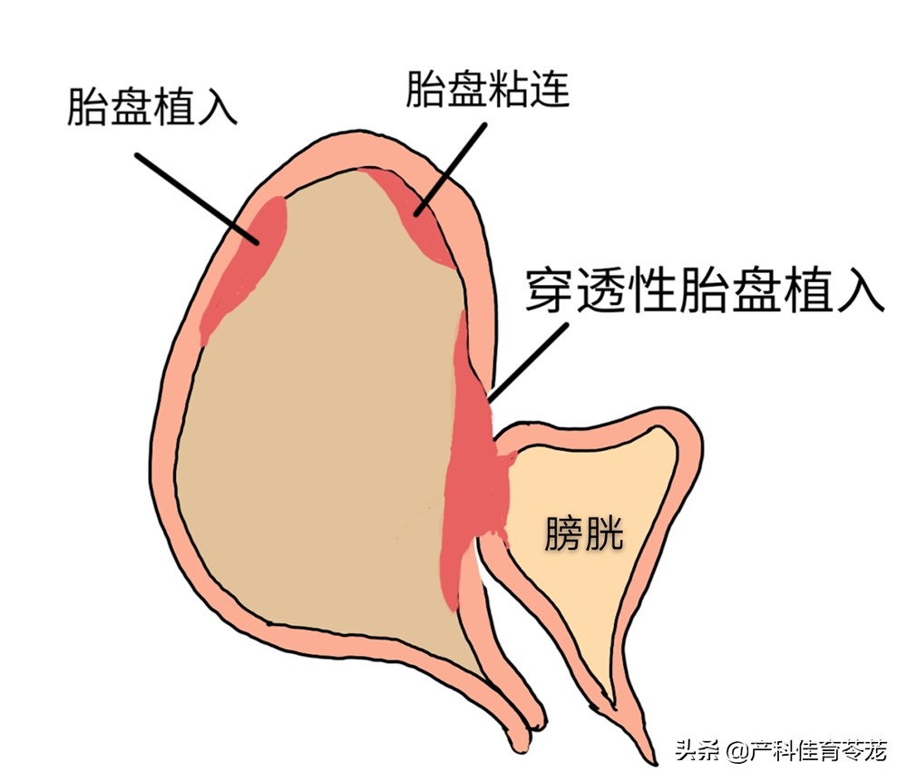 剖宫产术后并发症切口憩室,剖宫产发现胎盘植入怎么办