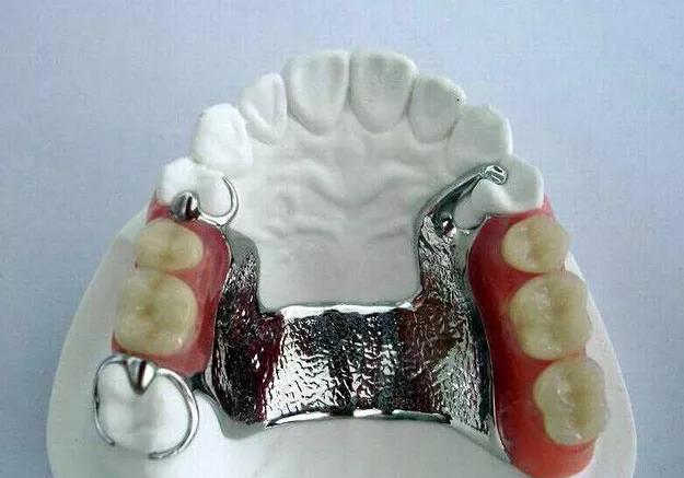 假牙松动重新粘合需要多少钱,种植牙松动可以拔掉重新种吗