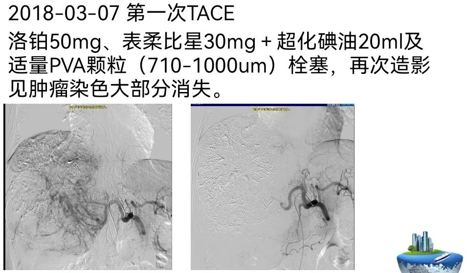 肝癌晚期靶向治疗怎么做,中国肝癌tace治疗展望