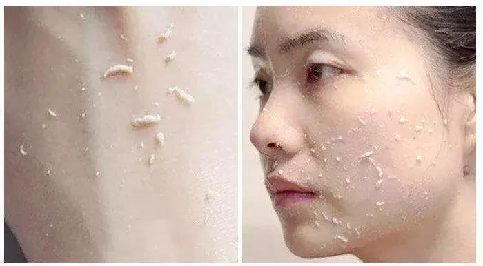 痘印祛痘药膏,痘印去除护肤品