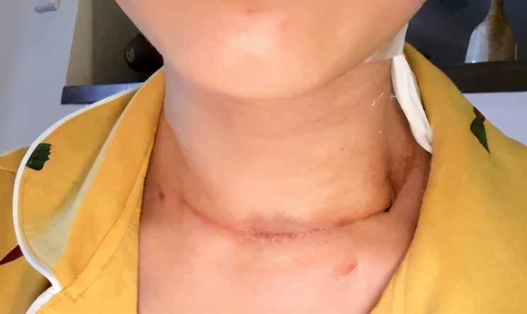 得了甲状腺女主播,主播甲状腺结节