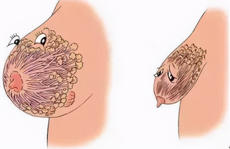 产后胸部干瘪下垂怎么恢复挺拔,产后胸部严重下垂可以做什么修复