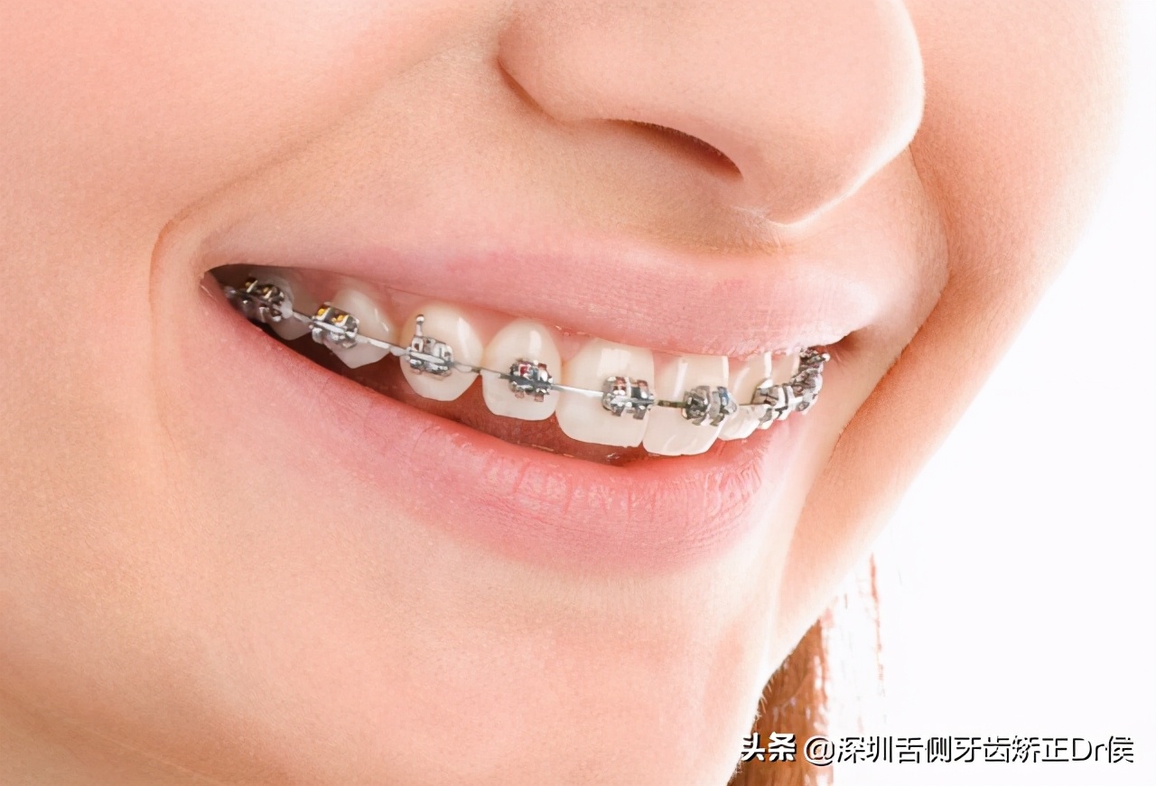 30岁以后还能牙齿矫正吗,30多岁还能牙齿矫正吗