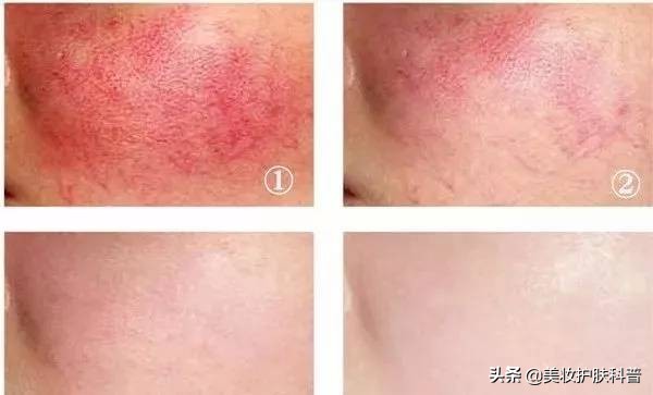 皮肤有血丝有点红怎么修复,红血丝养肤