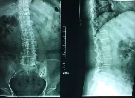 脊柱侧弯治好了，为什么患者反而治坏了？内附髋关节平衡松动法