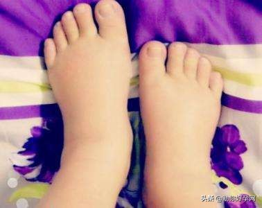 28周孕妈脚水肿是正常的吗,孕期水肿不可怕6招教你轻松缓解