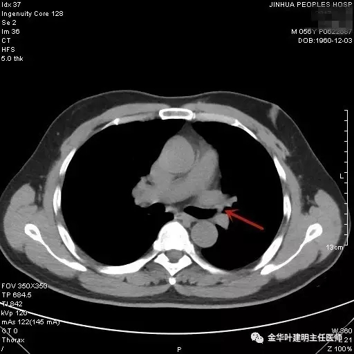 不典型鳞状细胞不明确可怕吗,不典型性鳞癌是什么