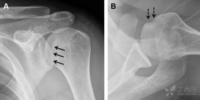放射科夜班病例大全,放射科容易漏诊的骨折