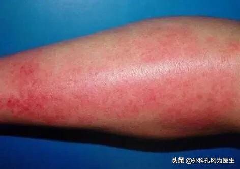 怎样判断得了丹毒,请问专家丹毒是怎么回事