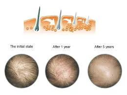 米诺地尔治疗脱发成功案例 (米诺地尔治疗脱发的正确使用方法)
