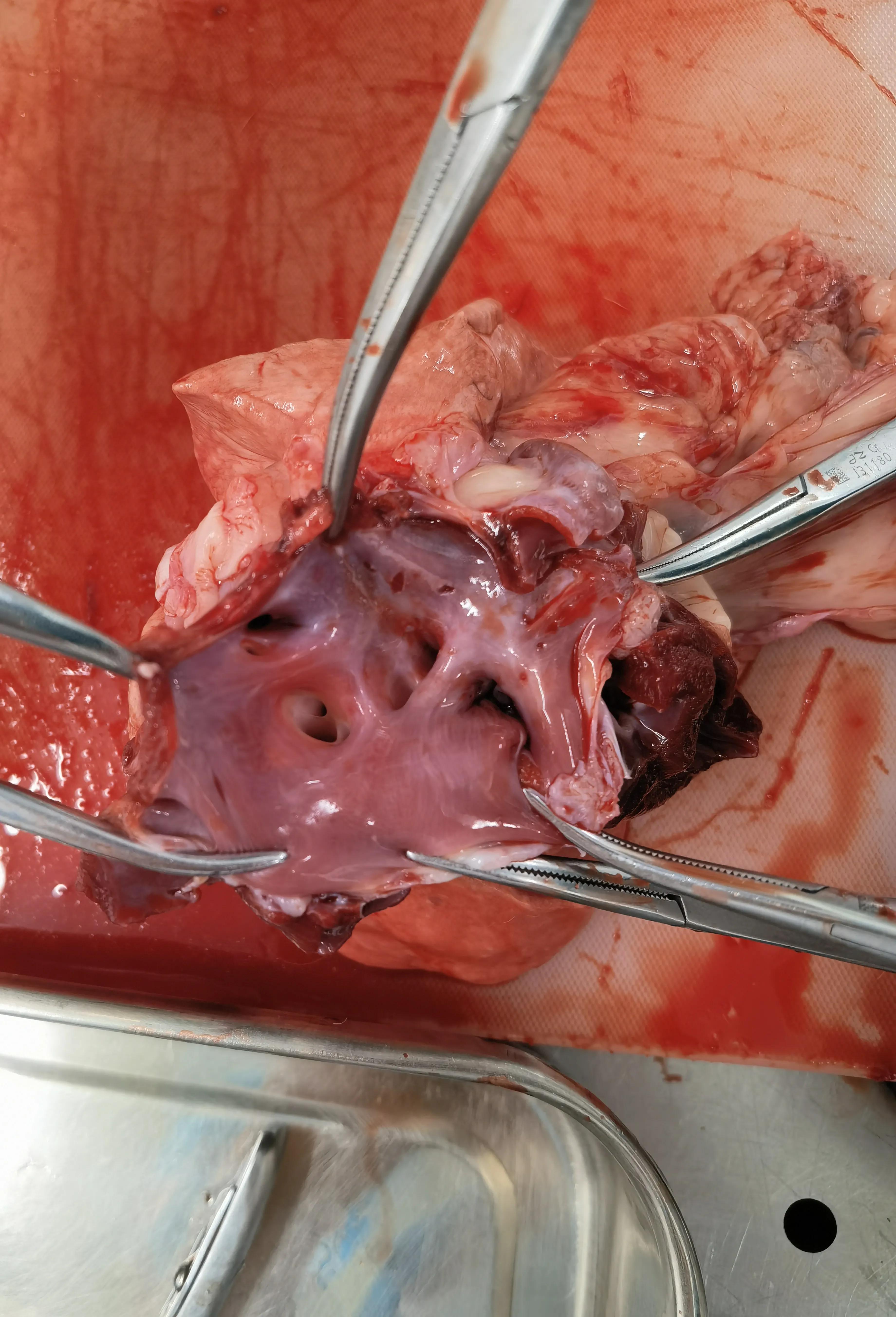 房颤射频消融术器械有哪些,脉冲消融治疗房颤品牌