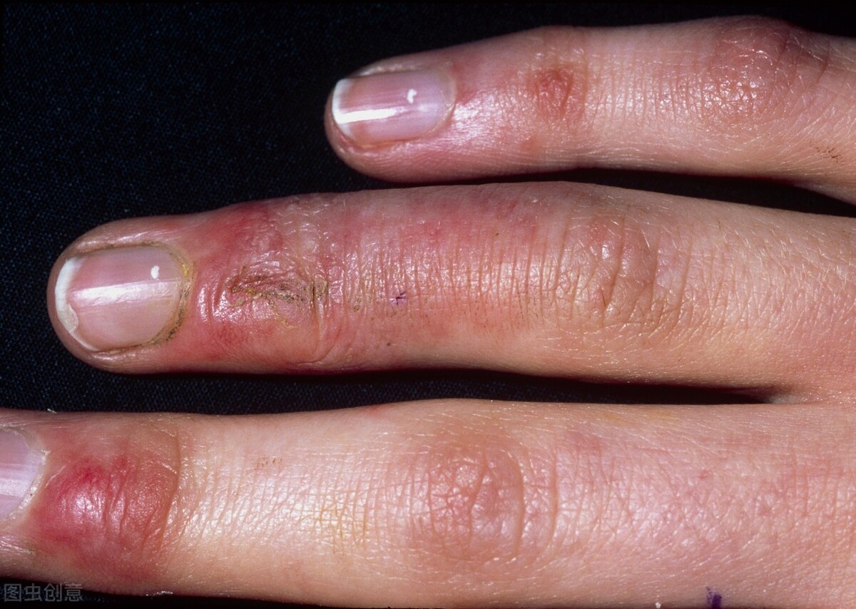 君子兰冻伤严重怎么办,严重冻伤为什么一定要截肢