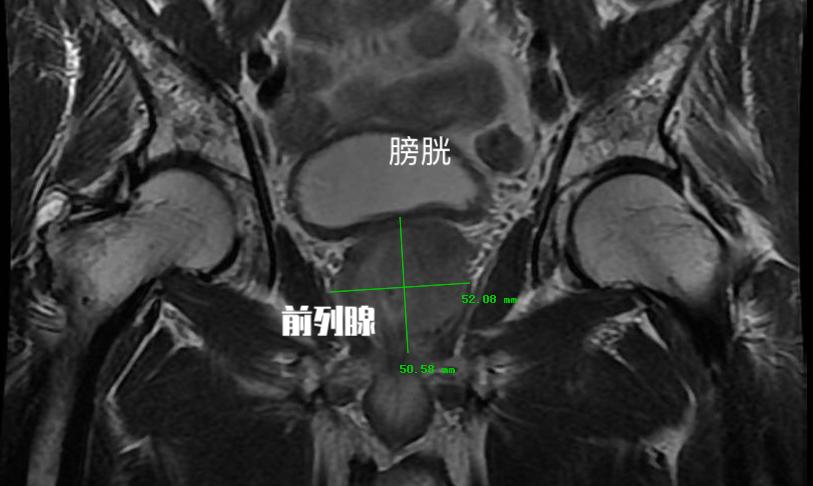 前列腺增生究竟治还是不治？不要着急说不！先了解下这些危险因素