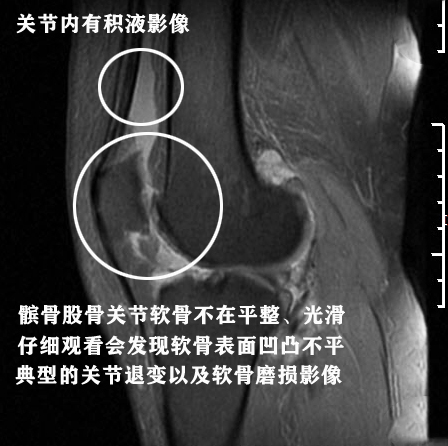怎样能看懂膝关节核磁图片,如何看懂膝关节磁共振报告