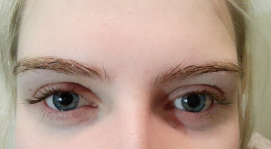 近视眼眼睛干涩用什么人工泪液,眼睛干涩滴生理盐水还是人工泪液