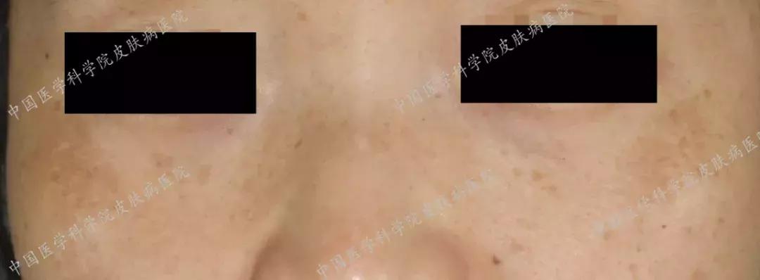 什么护肤品对晒斑有效,角质层薄有晒斑用什么护肤品