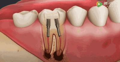 根管治疗可怕,根管治疗很恐怖吗