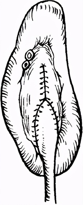 严重肾积水可以保守治疗吗,严重肾积水需要治疗吗