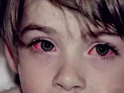 宝宝常见疾病大全与清晰护理策略,五种夏季儿童常见病该如何预防