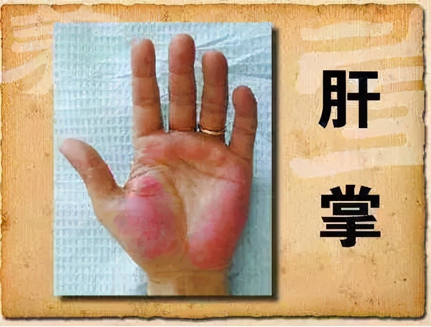 谷草转氨酶高会影响入职体检吗,体检谷草转氨酶ast偏高代表什么