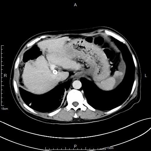 脾功能亢进导致血小板减少怎么办?