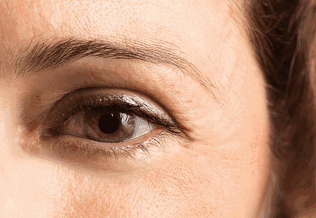 眼周除皱的最佳方法,眼周祛皱术后效果对比