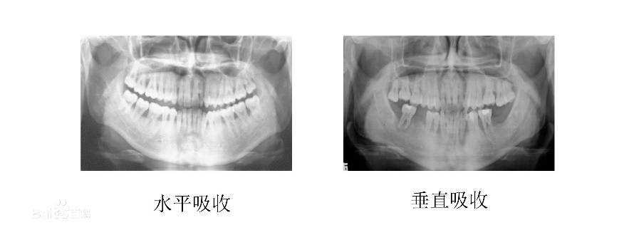 牙槽骨吸收牙根露出来怎么办,牙槽骨暴露会导致牙槽骨吸收吗
