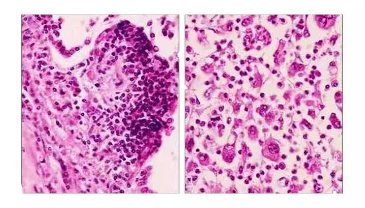 中央型肺癌和周围型肺癌的ct区别,中央型肺癌CT和支气管镜能看出吗