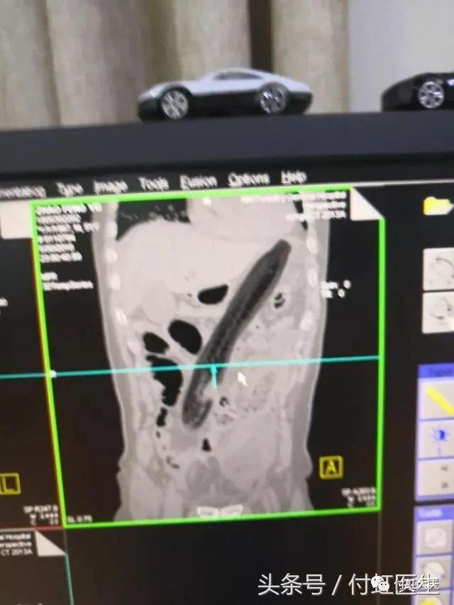 一条罗非鱼“游”进肛门？医生：直肠不直，进去容易出来难