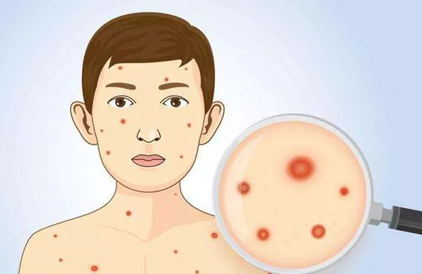 水痘年年有，今年稍稍多｜感染疾病科医生提醒：你该了解这些水痘小知识