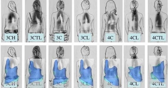 正骨推拿可以治疗颈椎侧弯吗,推拿针刀矫正带能治好脊柱侧弯吗