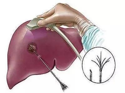 结节囊肿息肉哪一种容易得癌症,结节息肉囊肿